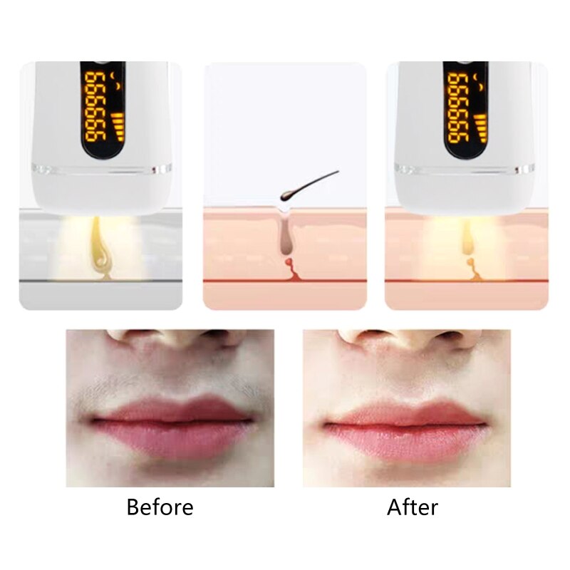 Photonic IPL Laser Hair Removal Instrument Multi-functional Portable Painless Hair Removal Instrument Your Lips Armpits(DYM-011)